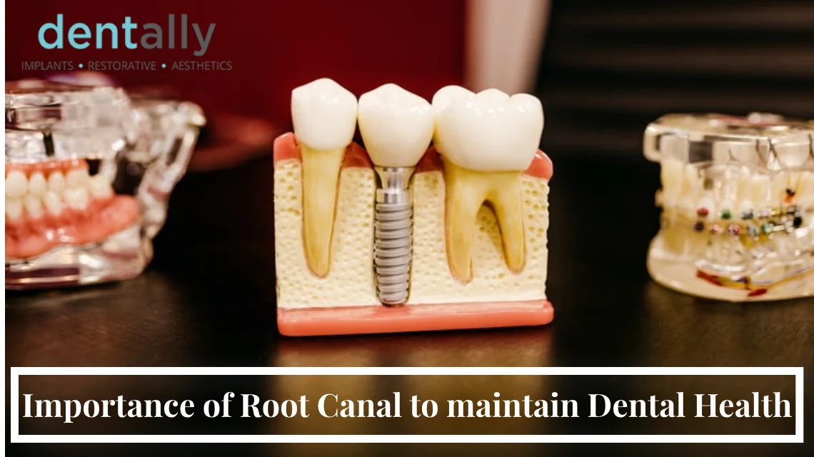 Importance Of Root Canal To Maintain Dental Health