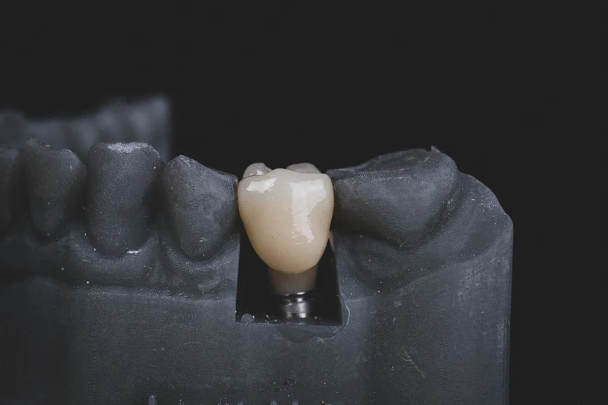 Everything You Need To Know About Dental Implant -  Dentally