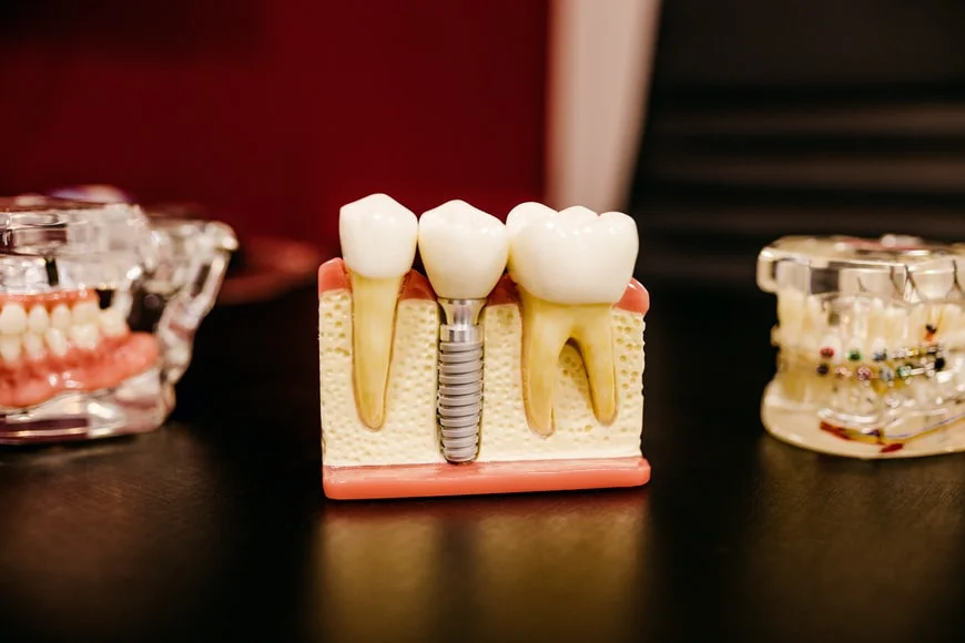 New Age Root Canal Treatment At Dent Ally -  Dentally