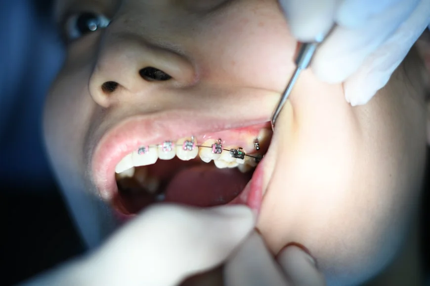 What To Consider Before Getting Braces? -  Dentally