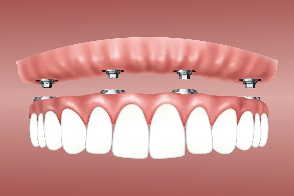 Are Dental Implants Appropriate For Children? -  Dentally