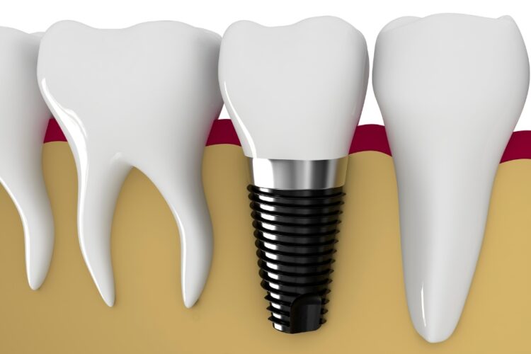 What are a few Alternative options to Dental Implants?