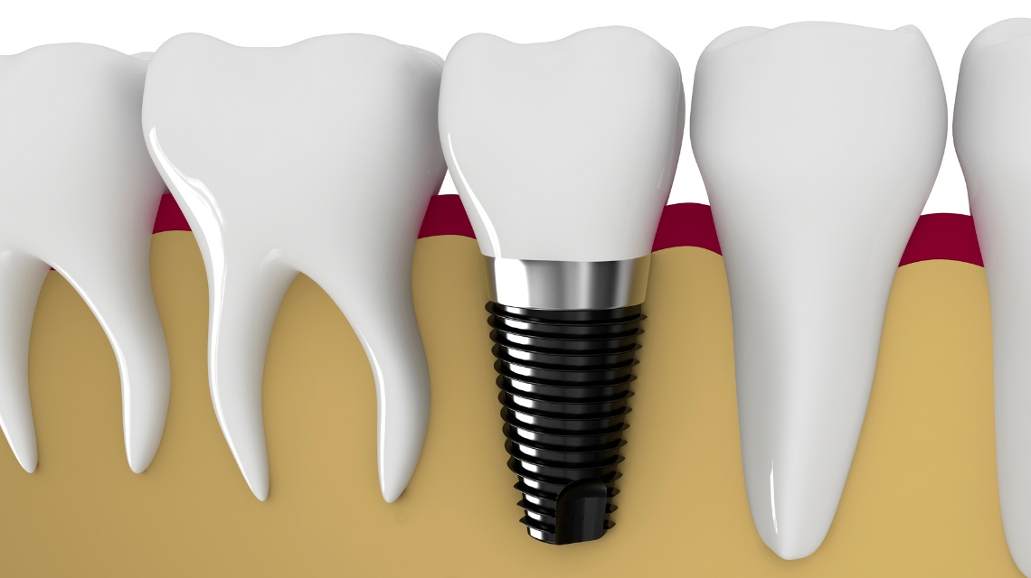 What are a few Alternative options to Dental Implants?