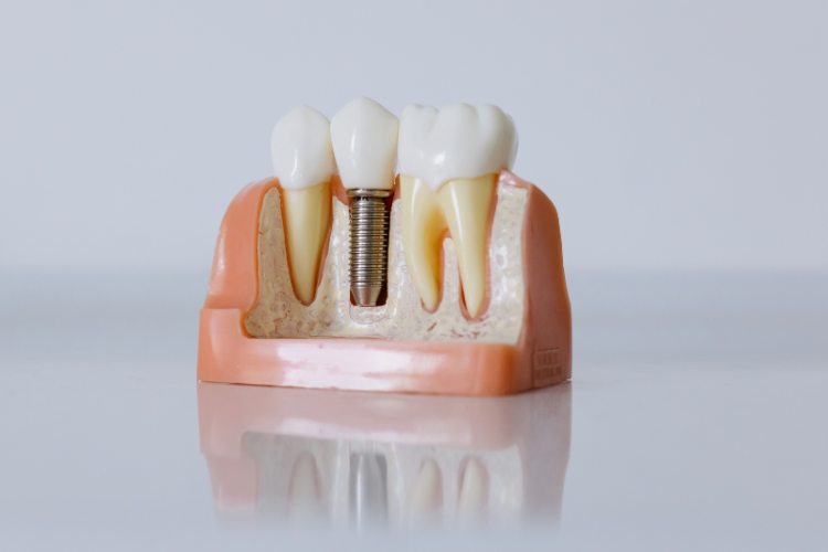 Dental Implant Success Rates What You Need to Know