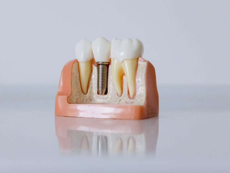 Dental Implant Success Rates What You Need to Know