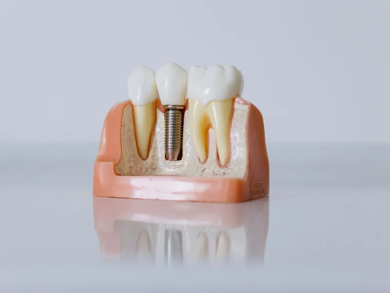 Dental Implant Success Rates: What You Need to Know -  Dentally