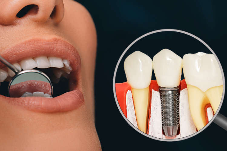 Dental Implants for Patients with Medical Conditions: What to Consider