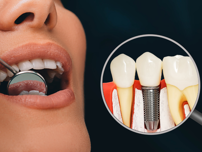 Dental Implants for Patients with Medical Conditions: What to Consider