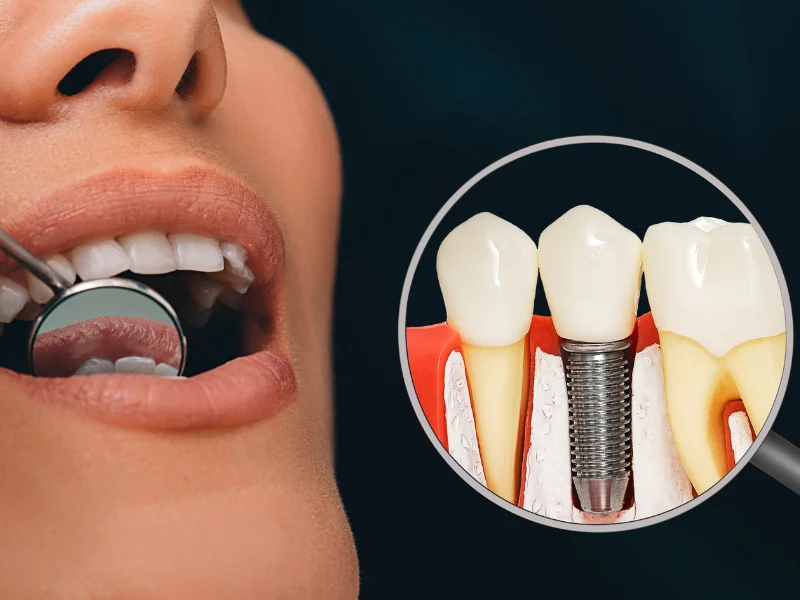 Dental Implants for Patients with Medical Conditions: What to Consider -  Dentally