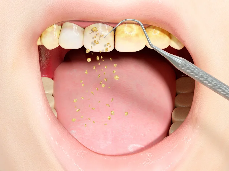 Oral Bacteria and Brain Abscesses -  Dentally