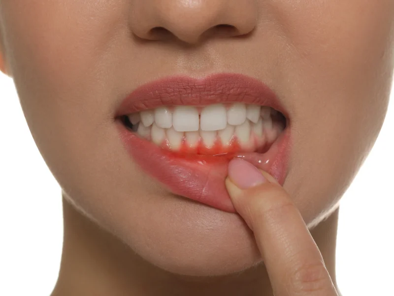 People Who Receive Periodontal Care Have Better Outcomes After Heart Attack -  Dentally