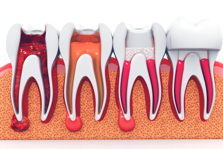 Preserving Natural Teeth with Root Canal Therapy