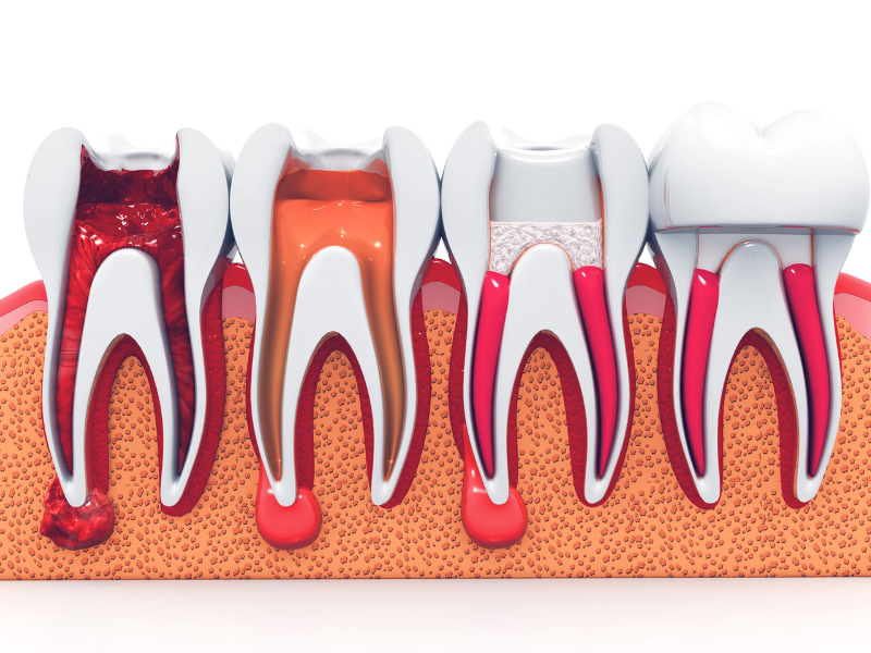 Preserving Natural Teeth with Root Canal Therapy