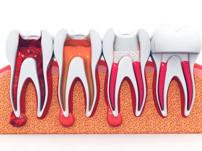 Preserving Natural Teeth with Root Canal Therapy -  Dentally