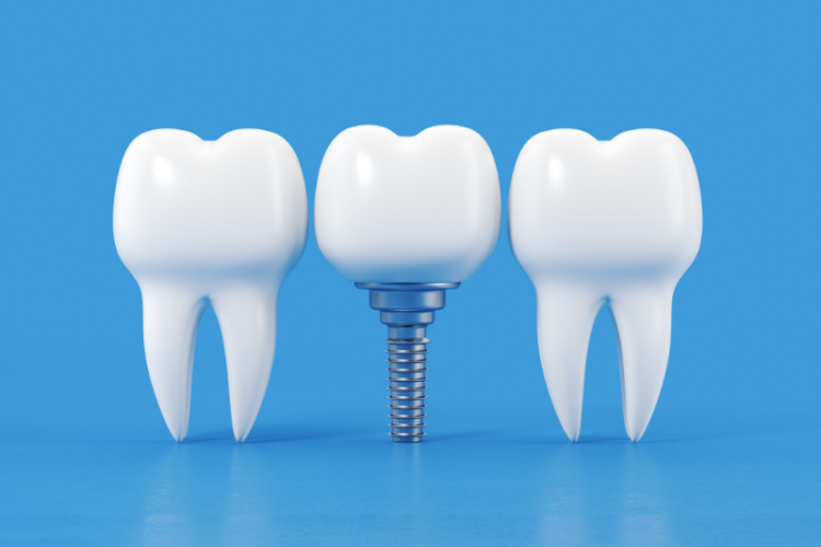 The Role of Bone Grafting in Dental Implantation