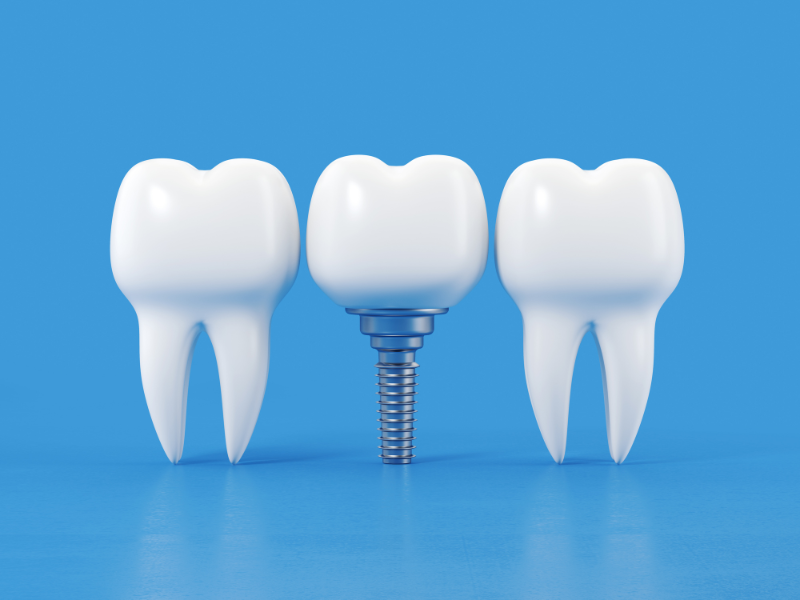 The Role of Bone Grafting in Dental Implantation