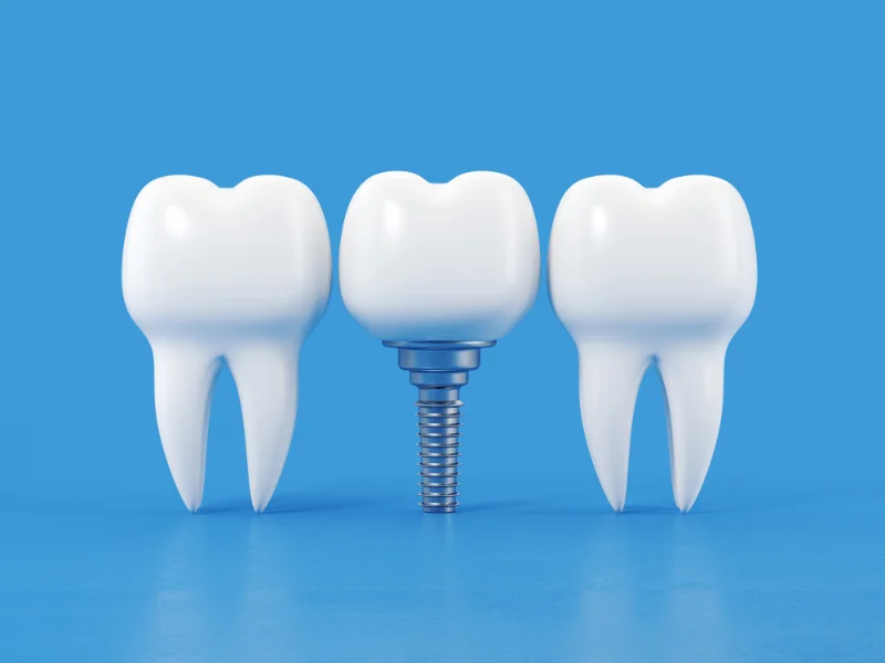 The Role of Bone Grafting in Dental Implantation -  Dentally
