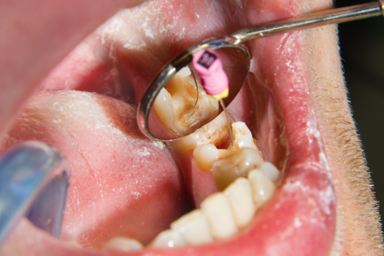 Optical Detection of Endodontic Infection A Game-Changer in Dental Care