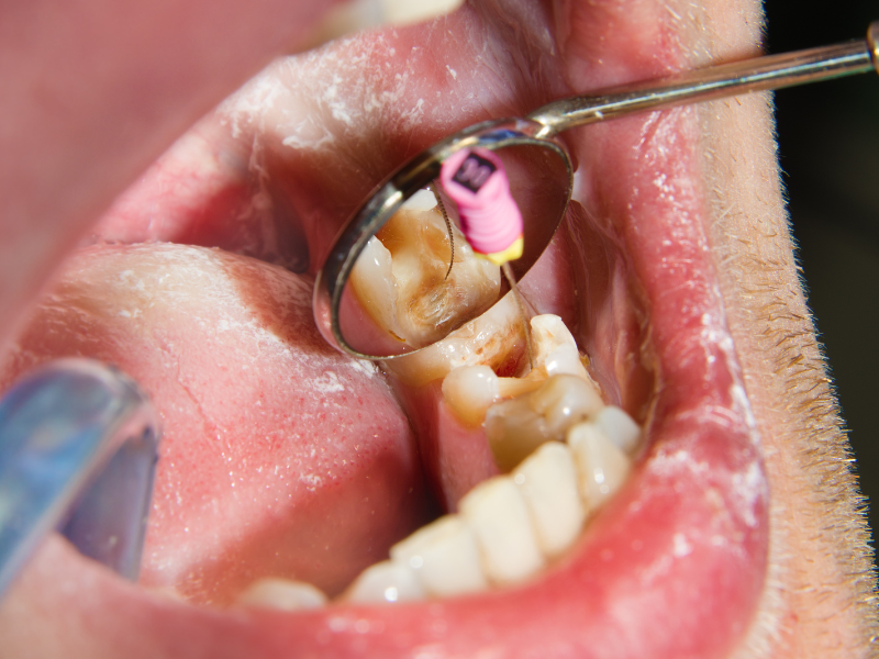 Optical Detection of Endodontic Infection A Game-Changer in Dental Care