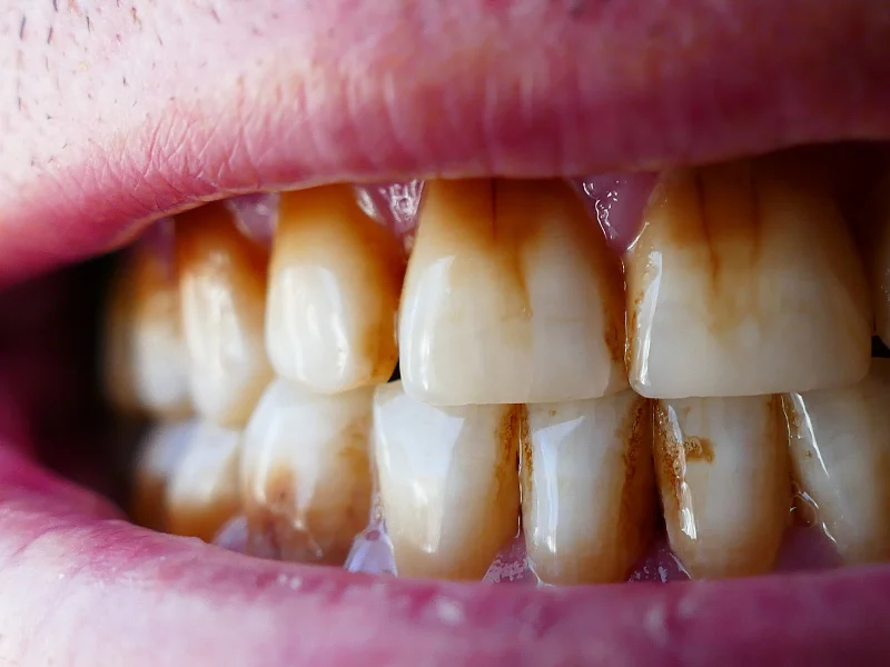 Why are my teeth yellow when i brush them everyday? -  Dentally
