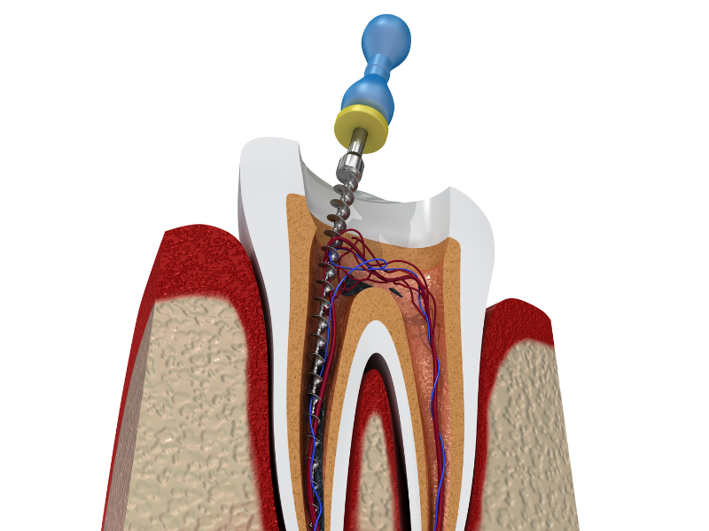 How Much Does Root Canal Treatment Cost in India