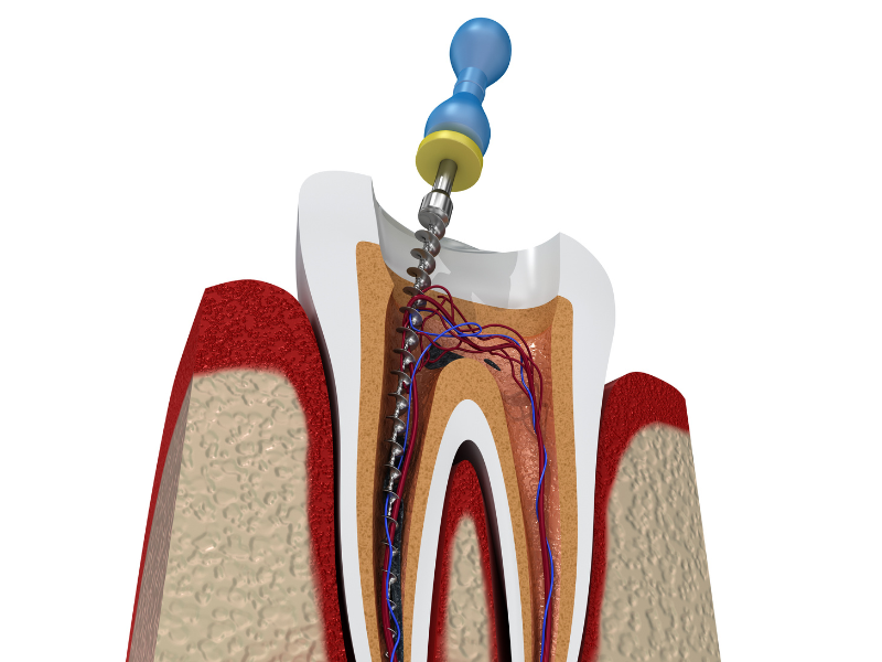 How Much Does Root Canal Treatment Cost in India? Dent Ally