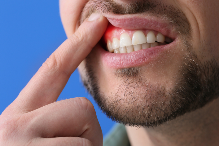 How to Cure Gingivitis in a Week Your Guide to Healthy Gums