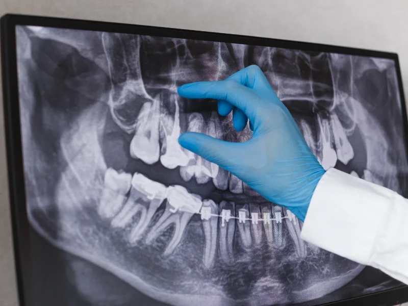 Advancements in Dental X-Rays: Safeguarding Dental Health in India with Improved Technology -  Dentally