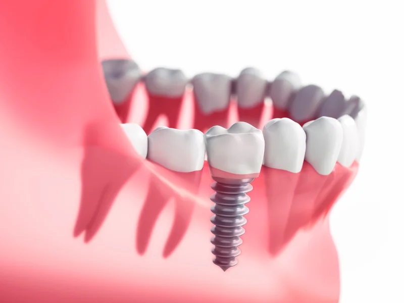 Elevating Smiles: Exploring the Diverse Advantages of Dental Implants -  Dentally