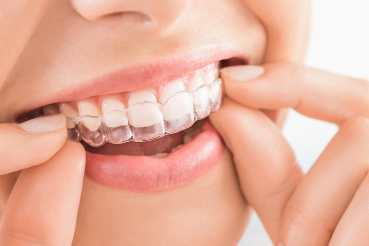 Transforming Smiles and Lifestyles: A Comprehensive Guide to Invisalign Treatment
