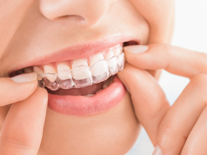 Transforming Smiles and Lifestyles: A Comprehensive Guide to Invisalign Treatment