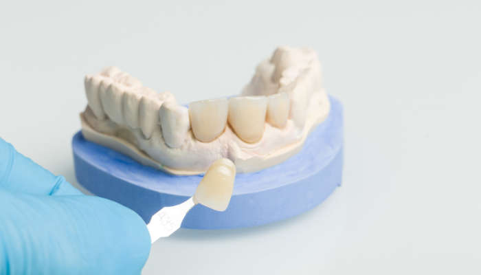 Best dental crowns treatment in Gurgaon