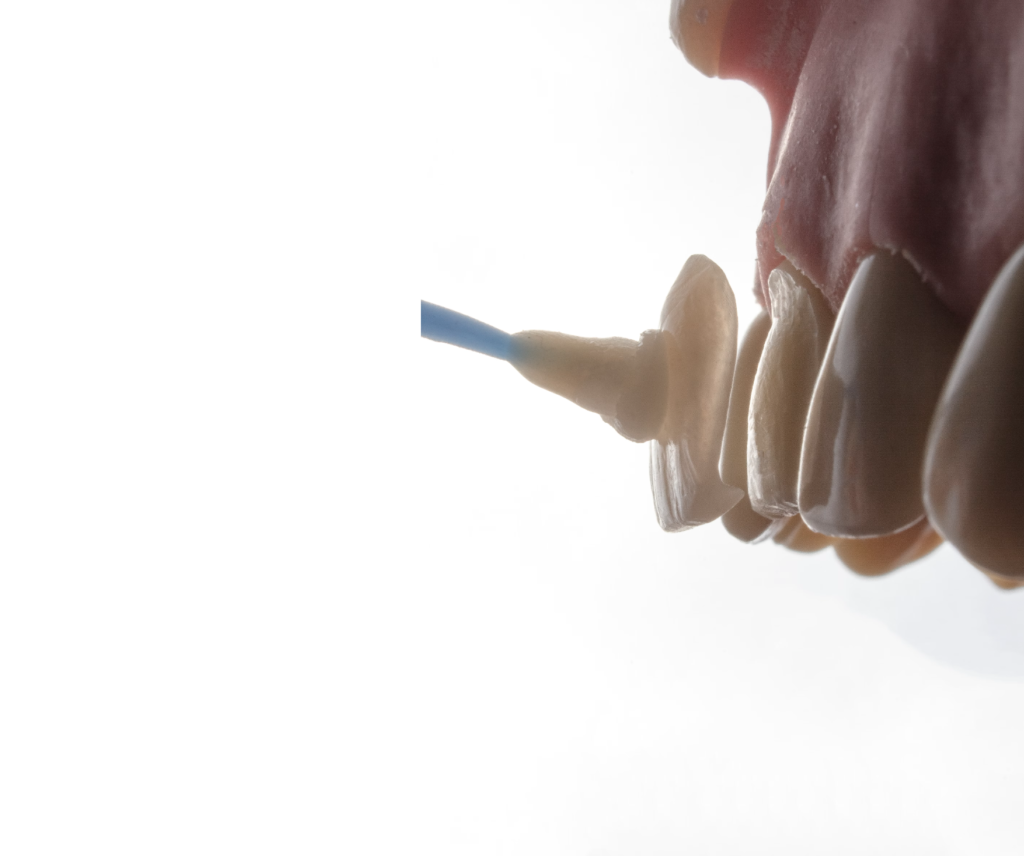 Can 1 implant support two teeth?