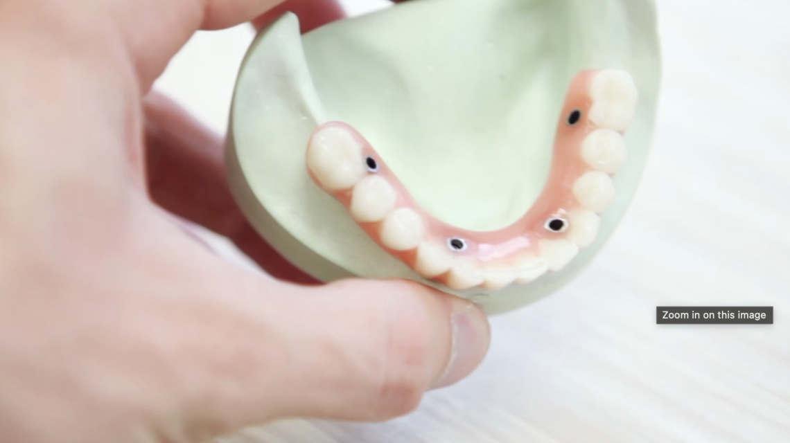 Can a dental implant be done in one day?