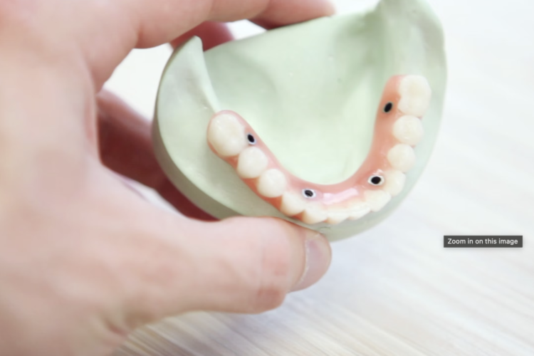 Can a dental implant be done in one day?