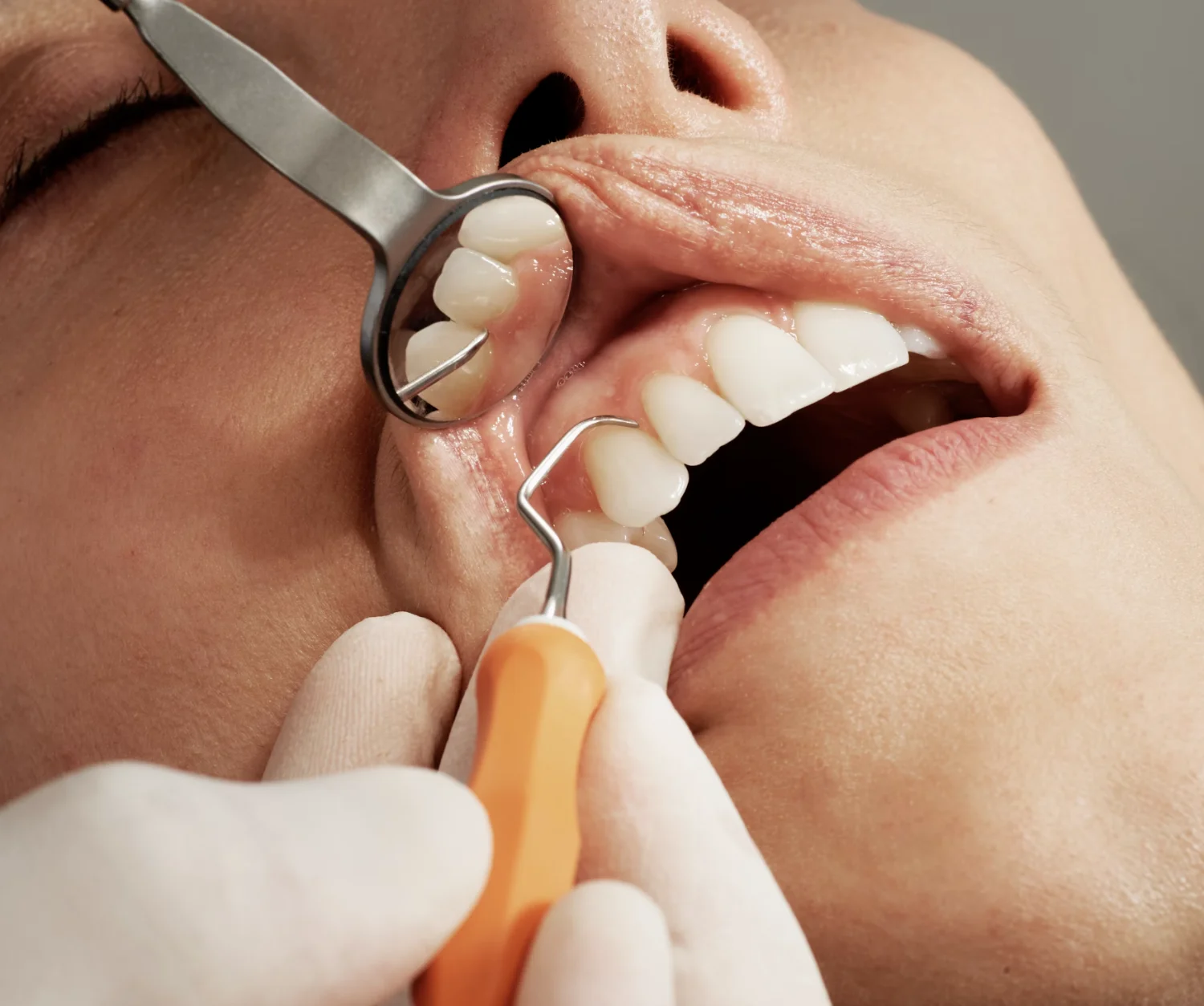 How long does a dental implant take to finish? -  Dentally