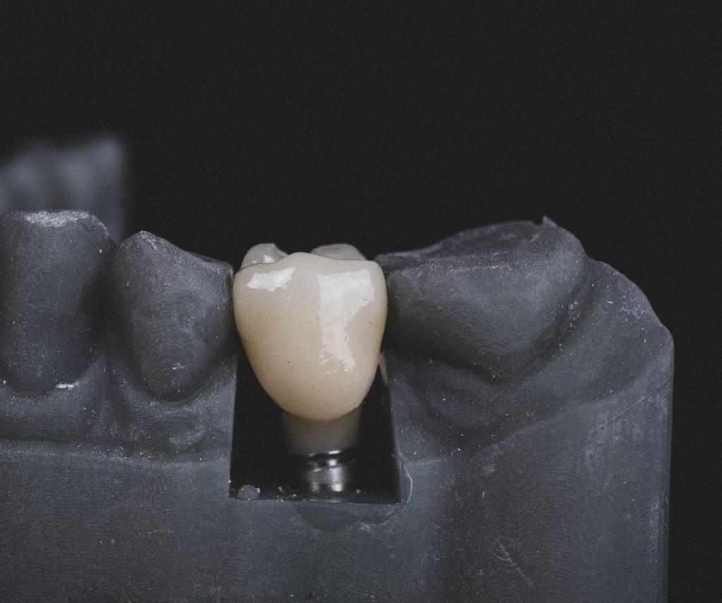 How painful is getting a dental implant?