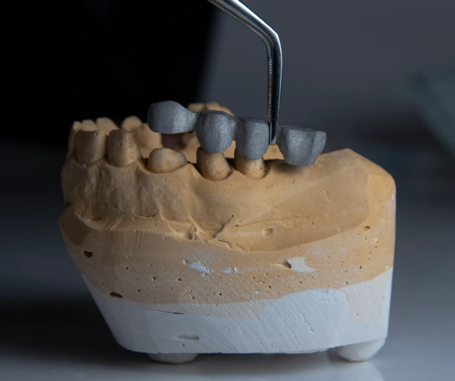 What is the most affordable way to replace missing teeth? -  Dentally