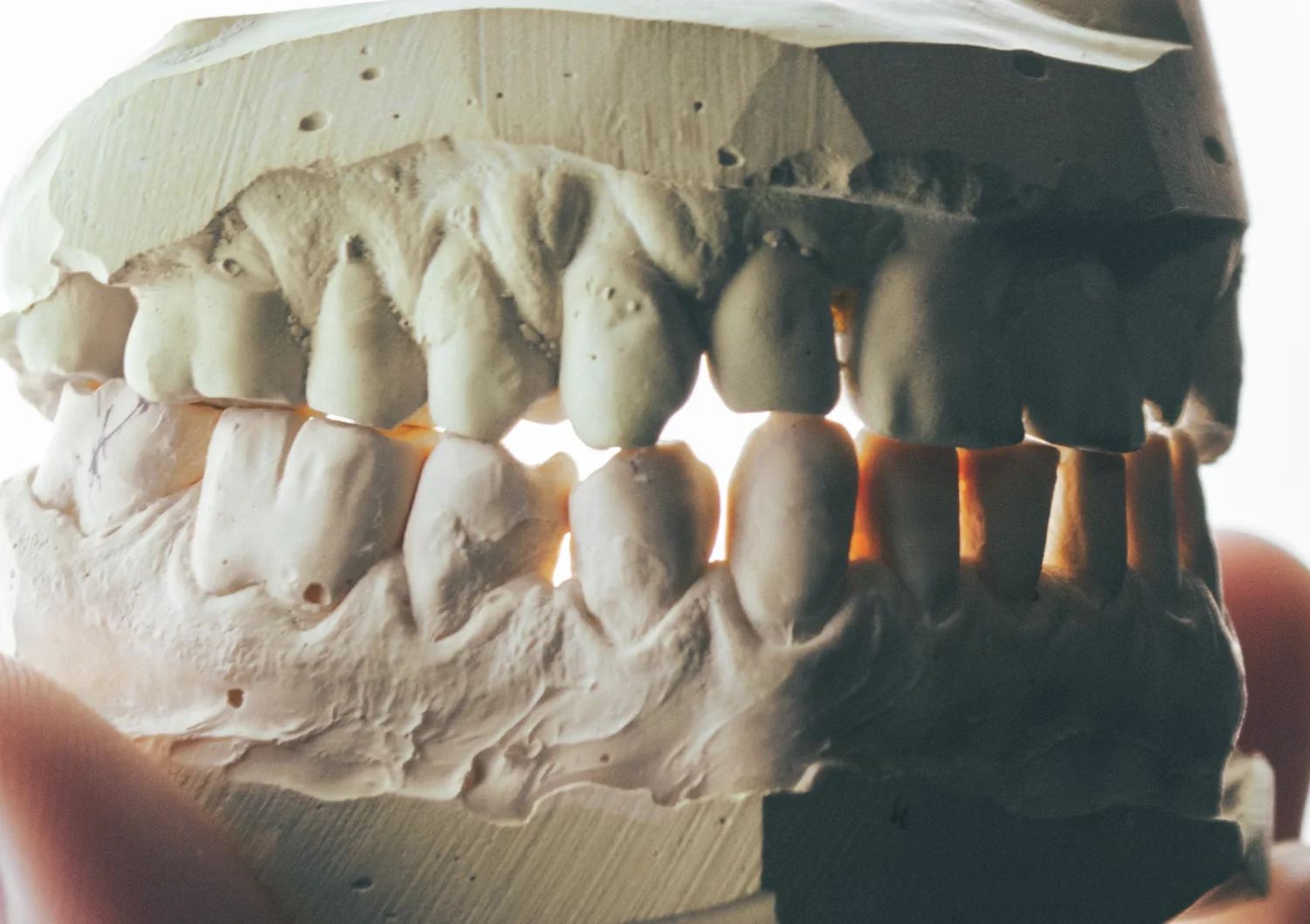 How to Repair Broken Teeth: Comprehensive Treatment Options -  Dentally