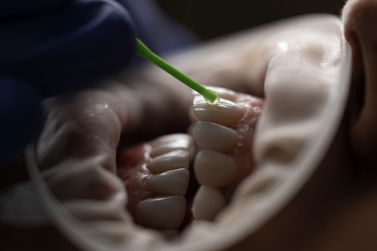 Understanding Different Types Of Tooth Stains And Effective Removal Methods