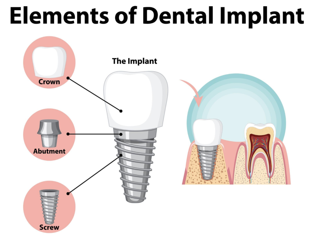 Dental Implants In Delhi, Implant Dentist In Delhi | Dentally - Dent Ally