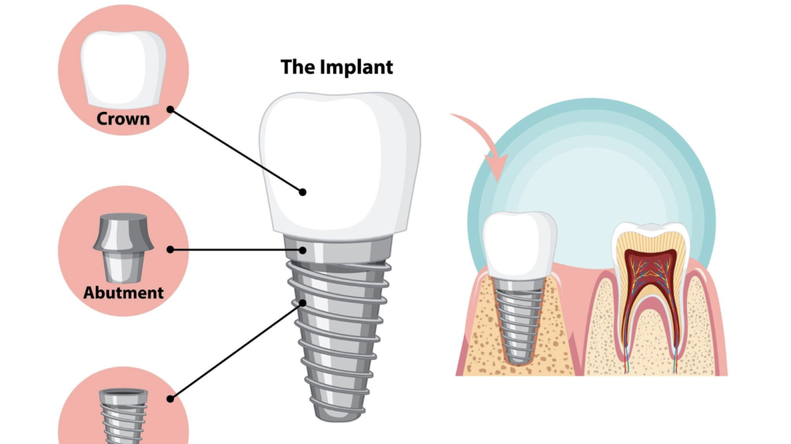 Titanium Implant Side Effects and How to Minimize Your Risk