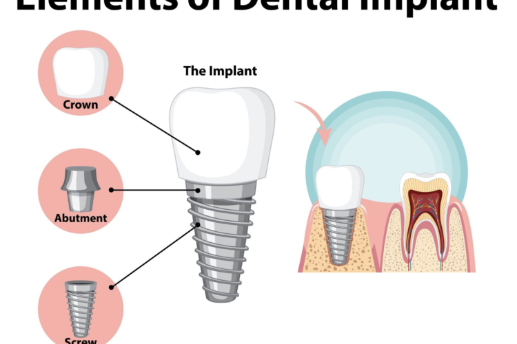 Titanium Implant Side Effects and How to Minimize Your Risk