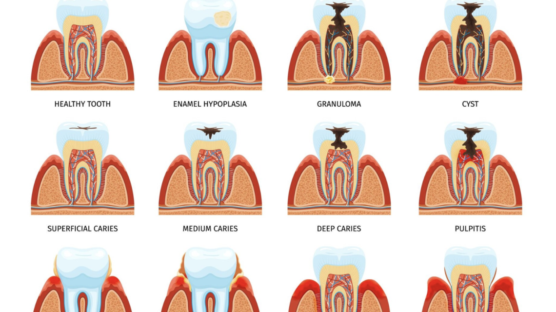 What Should You Do About a Wisdom Tooth Cavity