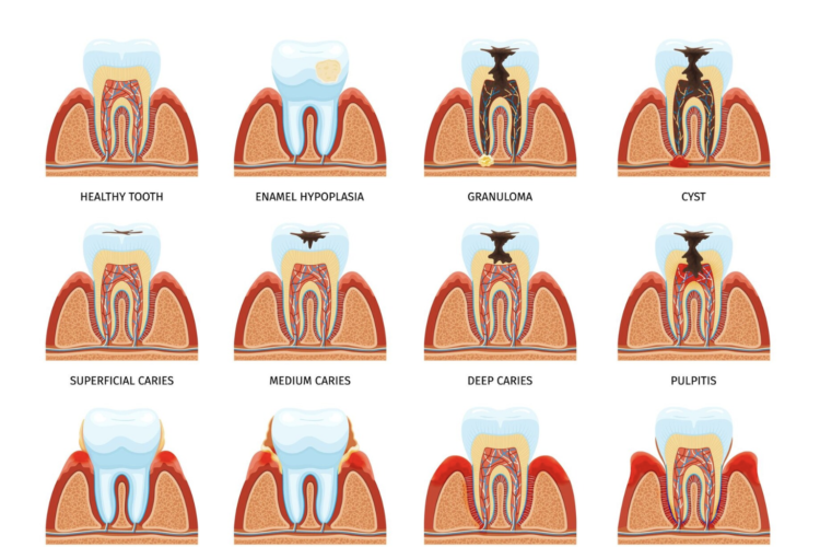 What Should You Do About a Wisdom Tooth Cavity