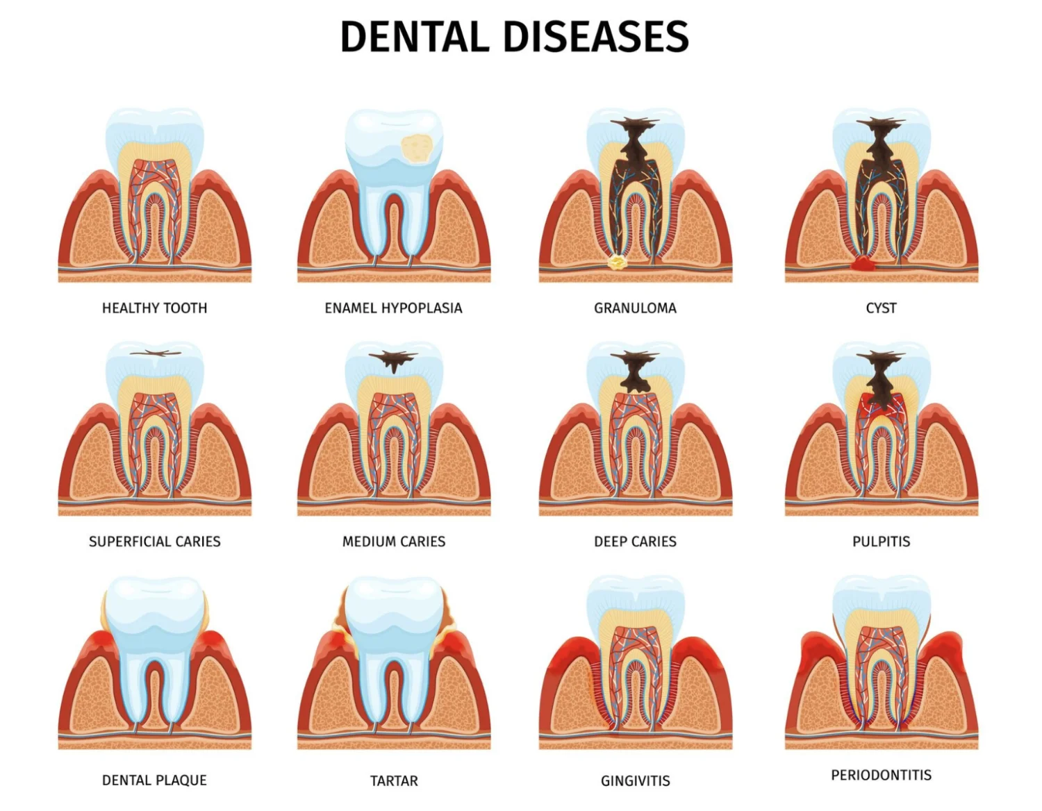 What Should You Do About a Wisdom Tooth Cavity? -  Dentally