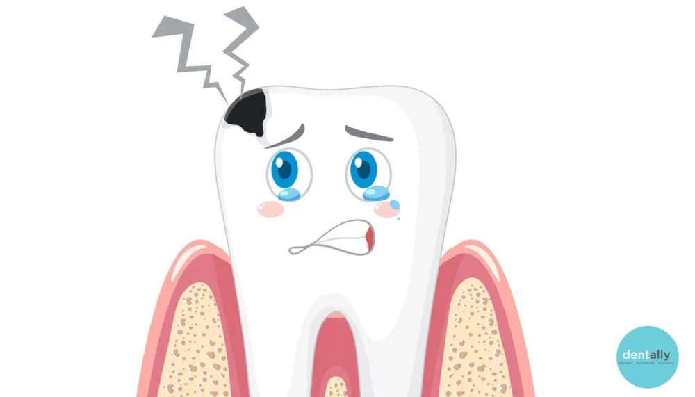 What Happens If Half of Your Tooth Breaks Off?