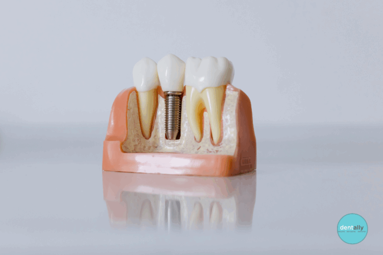Best Countries for Dental Implants in 2025: A Comprehensive Guide
