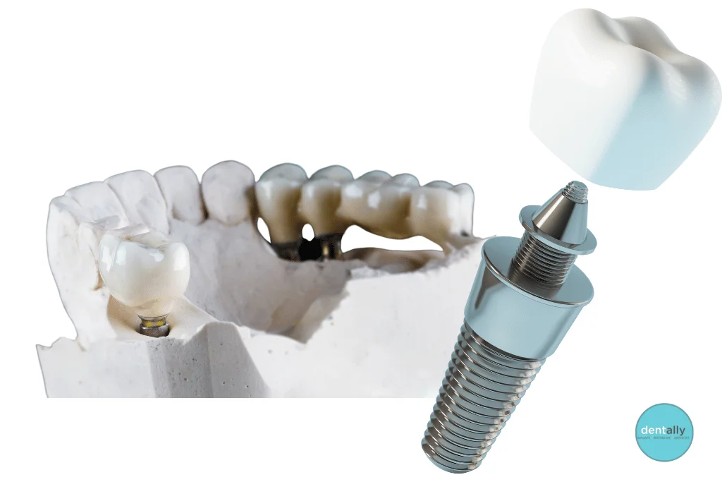 Dental Bridge vs Implant: What’s the Best Option for You? 🦷⚖️ -  Dentally