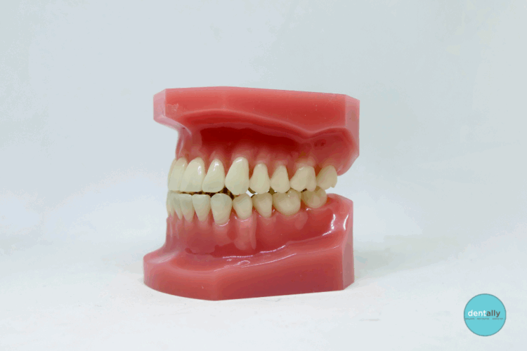 Photos of Abscess on Gums